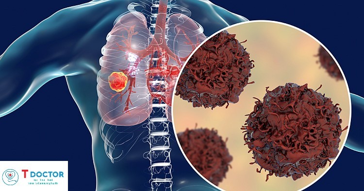 Ung thư phổi - Bệnh ung thư phổi có lây không?